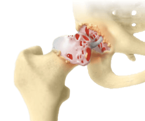 Darstellung eines Hüftgelenks mit Arthrose