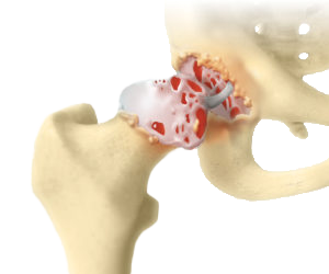 Darstellung eines Hüftgelenks mit Arthrose