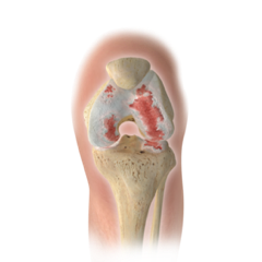 Darstellung einer Kniegelenksarthrose